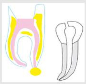 Endodonzia e cura canalare 