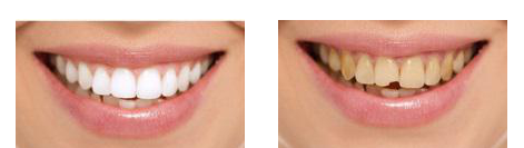 Prima e dopo l'intervento di bonding dentale