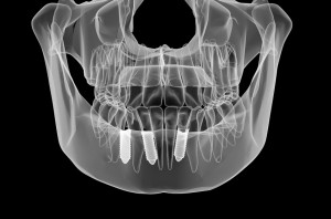 Scanner Impianti dentali implantologia avanzata a Padova