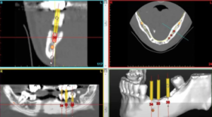 Tac Implantologia avanzata a Padova