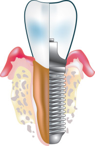 Progettazione impianti dentali - Implantologia estetica